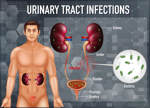 An image of a Urinary tract infection 