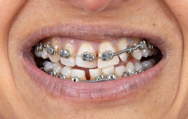 Metal braces on crooked teeth of middle age Indian.