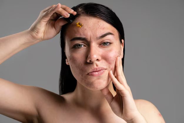 A lady with pre-menstrual breakouts 